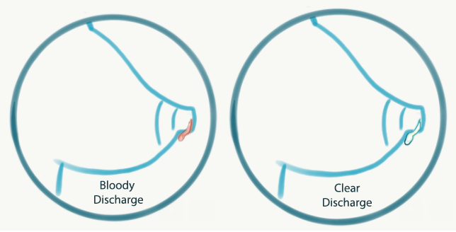 nipple discharge other than milk bloody discharge nipple discharge other than milk lymph discharge